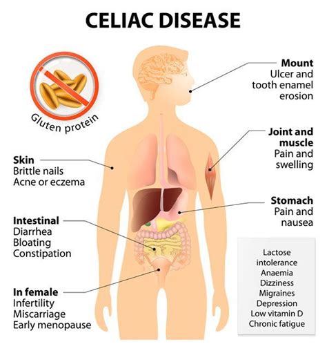 Celiac Disease Treatments Natural Remedies Nutrition Wellness Center