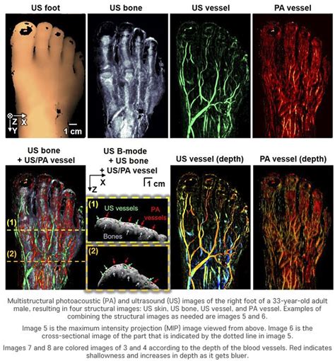 D Bimodal Photoacoustic Ultrasound Imaging To Diagnose Peripheral