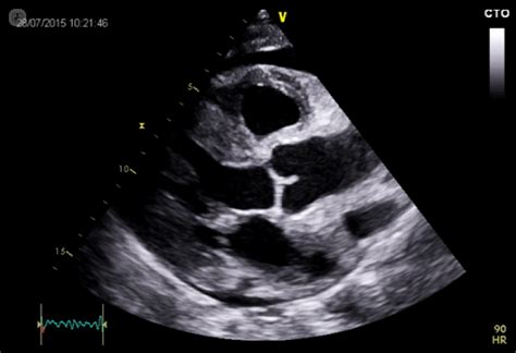 Normal Echocardiogram