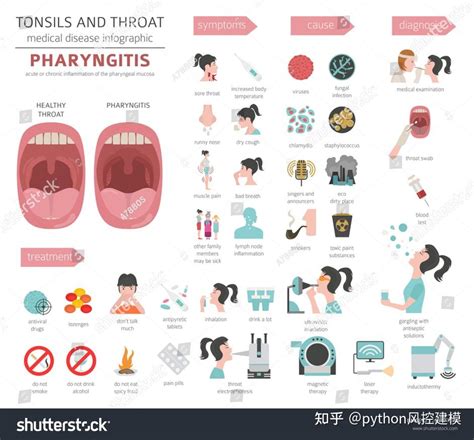 一图读懂慢性咽喉炎chronic Pharyngitis 知乎