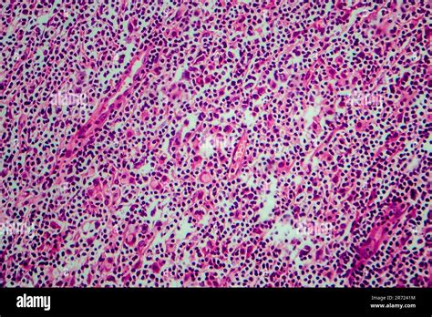 Hodgkins Lymphoma Light Micrograph Photo Under Microscope Stock