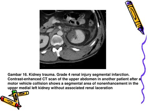 Ppt Trauma Urogenital Powerpoint Presentation Free Download Id9616467