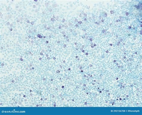 Systemic Mastocytosis Toluidine Blue Stain Stock Illustration