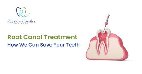 Root Canal Treatment How We Can Save Your Teeth Robstown Smiles