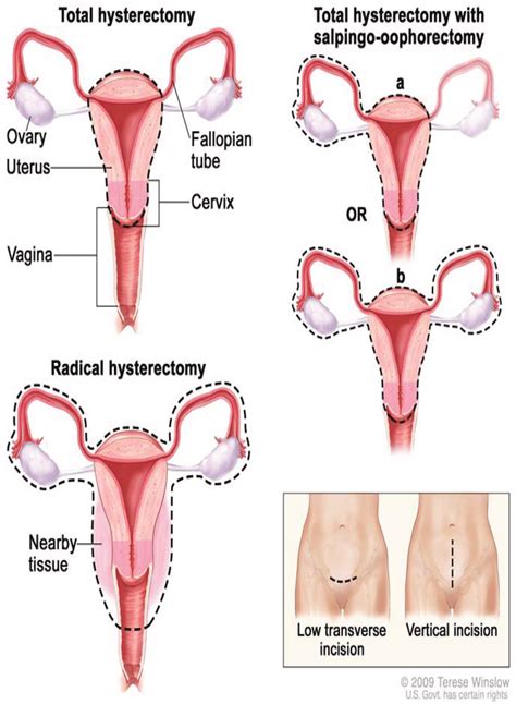 Types Of Hysterectomy Source Download Scientific Diagram