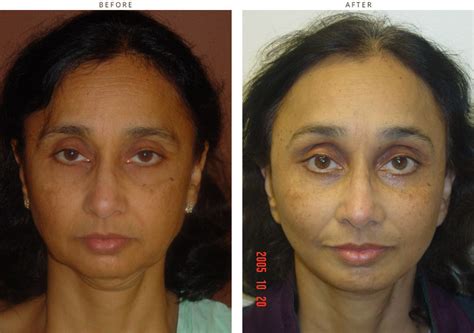 Mid Face Lift – Before and After Pictures * – Dr Turowski – Plastic ...