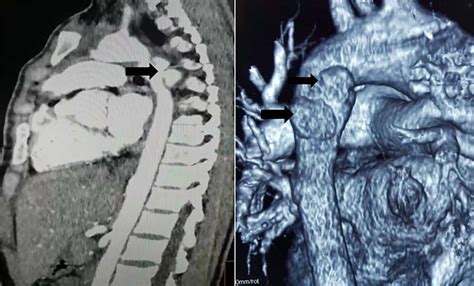 Ct Scan Showing Two Mycotic Pseudoaneurysms Of The Descending Aorta