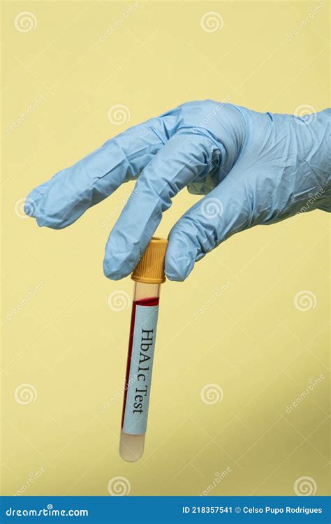 Hand With Rubber Glove Holding Vacuum Tube Of Blood To Do Hba1c