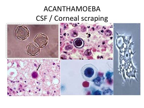 Free Living Amebae Naegleria Fowleri Acanthamoeba Balamuthia Ma