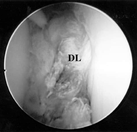 Pdf Arthroscopic Diagnosis Of Tibiofibular Syndesmosis Disruption