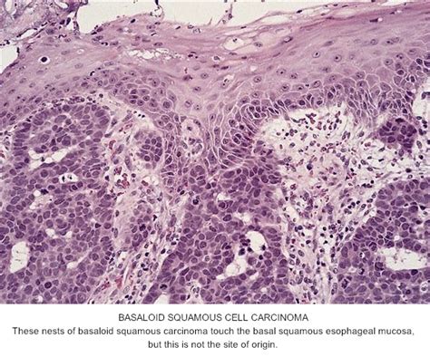 Pathology Outlines Basaloid Squamous Cell Carcinoma