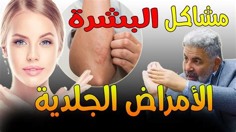 3 مشاعر تخلصي منها و لاحظ الفرق في حياتك الصدفية، الاكزيما