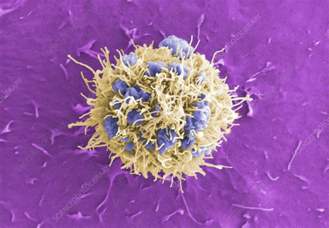 Cervical Cancer Cell SEM Stock Image C059 7490 Science Photo Library