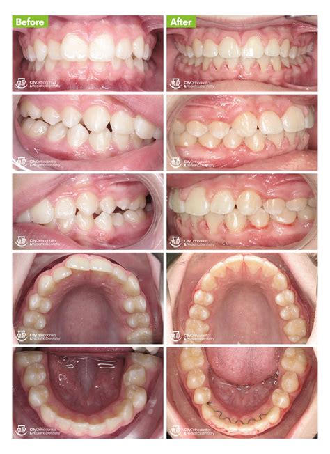 Invisalign Before And After Overjet