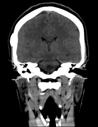 Skull Osteoma Image Radiopaedia Org