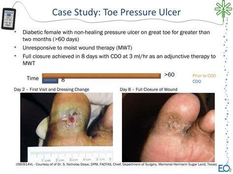 Ppt Case Study Toe Pressure Ulcer Powerpoint Presentation Free