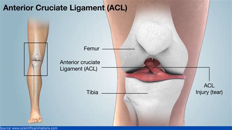 ACL Injury What You Should Know Dr Dilip Mehta