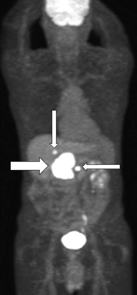 Metastatic Paraganglioma—Role for External Beam Radiation Therapy | Oncohema Key