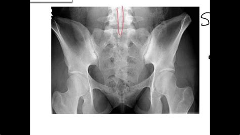 Coccyx X Ray Positioning