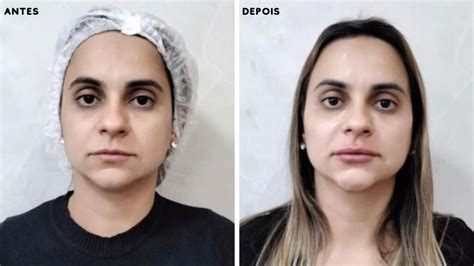 Quanto Tempo Dura Preenchimento Labial Confira