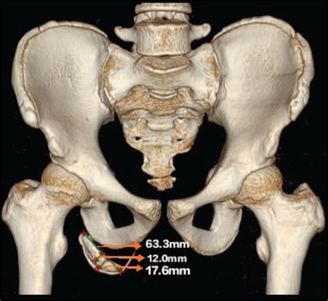 Surgical Treatment For Acute Ischial Tuberosity Avulsion Fracture A