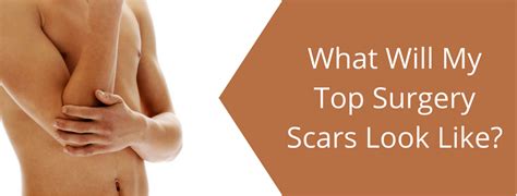 What Will My Top Surgery Scars Look Like Mclean Clinic