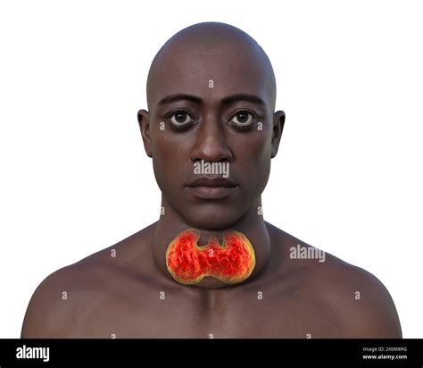 3d Illustration Of A Man With An Enlarged Thyroid Gland Goitre Base