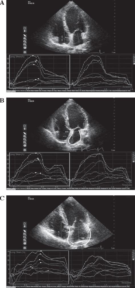 Figure 1 From Left Atrial Function Examination Of Healthy Individuals