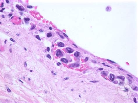 Intravascular Large Cell Lymphoma - 2.