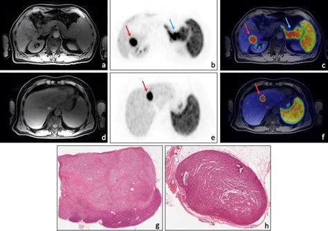 Ga Dotatoc Pet Mri Performed For Pannet Staging A Year Old