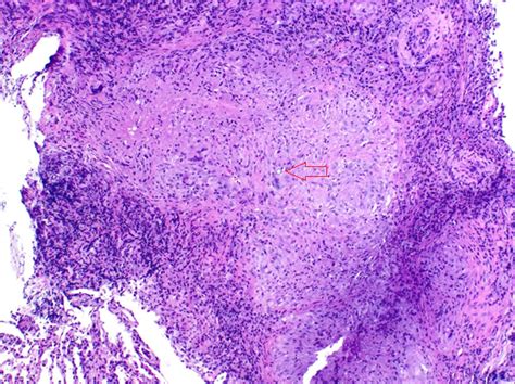 Microbiology Case Study A Year Old Male With High Fevers And