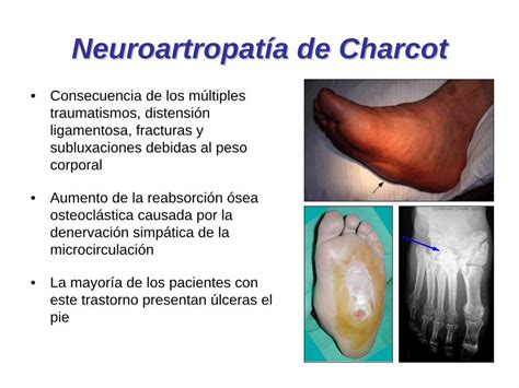 PDF Pie diabético moliner san gva es Las úlceras neuropaticas