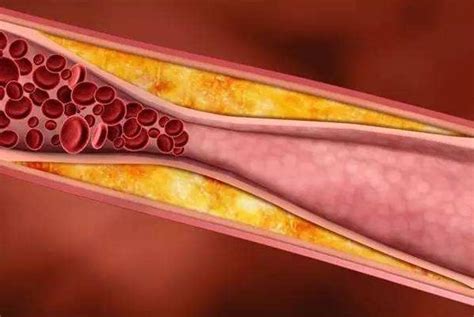 动脉难逃一“硬”，动脉硬化会有什么症状？