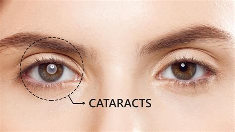 Cataract Symptoms