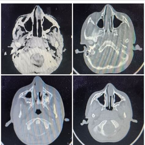 A CT scan of the nose and paranasal sinuses. A soft tissue mass filling... | Download Scientific ...