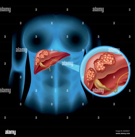 Liver Cancer Diagram In Detail Stock Vector Image And Art Alamy