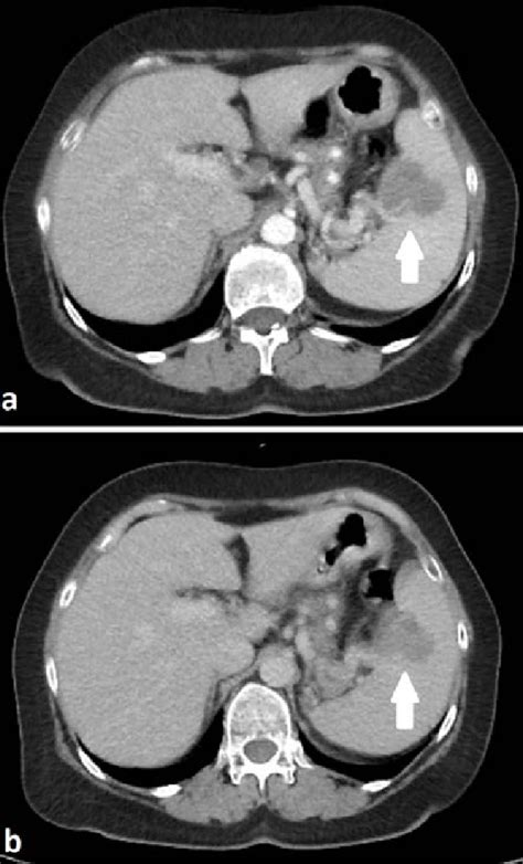 Contrast Enhanced Axial Computed Tomography Scans Of The Upper Abdomen