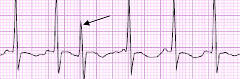 Premature junctional complex 4. Bradyarrhythmias 4.1 Sinus node ...