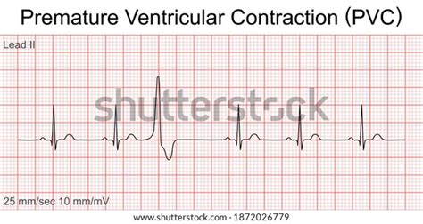 Electrocardiogram Show Premature Ventricular Contraction Pvc Wektor