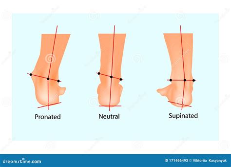 Vector Illustration of the Normal Human Foot and the Foot with ...