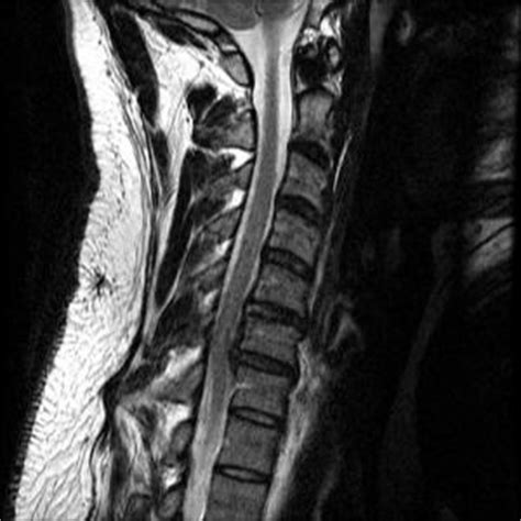 Surgery for cervical herniated disc | General center | SteadyHealth.com