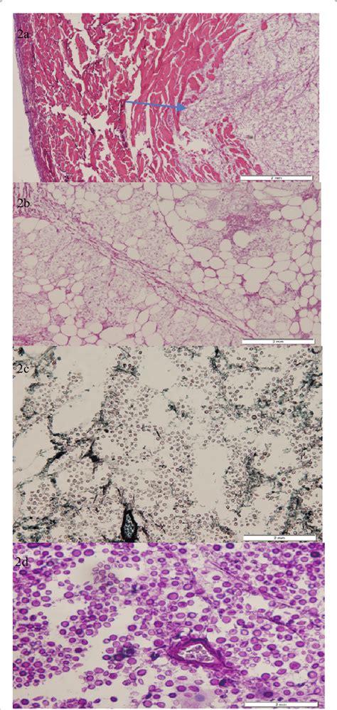 a) Histological section showing partially necrotic skin and ...