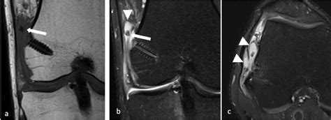 Figure 1 From Iliotibial Band Reconstruction With Allograft Fasciae