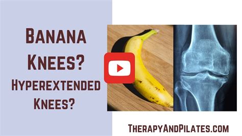 Do You Have Hyperextended Knees Banana Knees Try These Knee Hyperextension Exercises Youtube