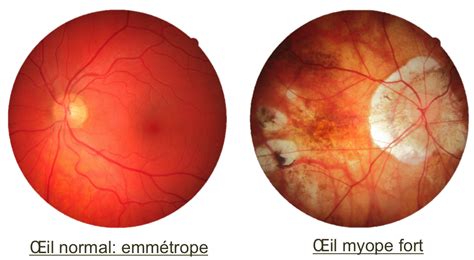 Pathologies Oculaires Centre Ophtalmologique Rabelais