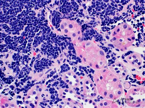 Chronic Lymphocytic Leukemia Small Lymphocytic Lymphoma Arkana