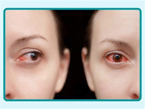 Inflammation Of The Eye Symptoms Causes And Treatment Inflammatory