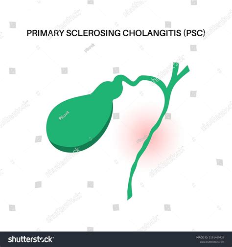 Primary Sclerosing Cholangitis Concept Psc Gallbladder Stock Vector Royalty Free 2191460429