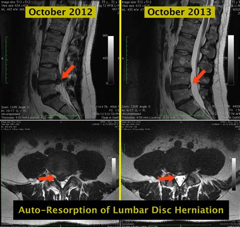 Kode Icd 10 Herniated Nucleus Pulposus Ikon Gambar Icon Dan Fungsinya