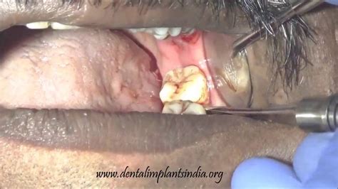 Second Third Mandibular Molar Extraction By Cowhorn Forceps Youtube